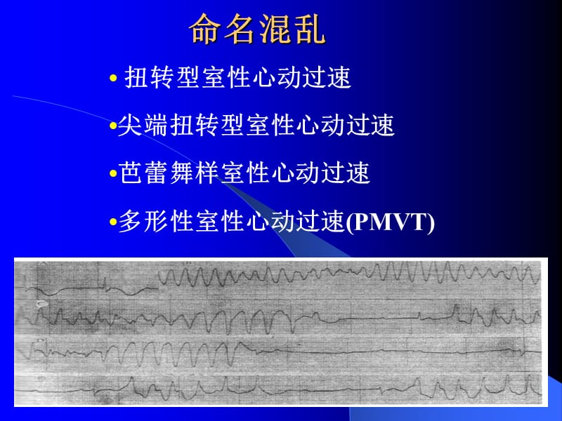 扭转型室性心动过速.ppt_第3页