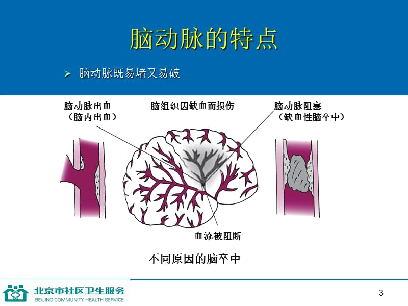 第十一讲防治脑卒中.ppt_第3页