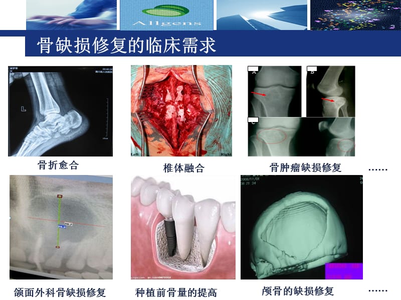 奥精骼金产品仿生骨介绍.ppt_第3页