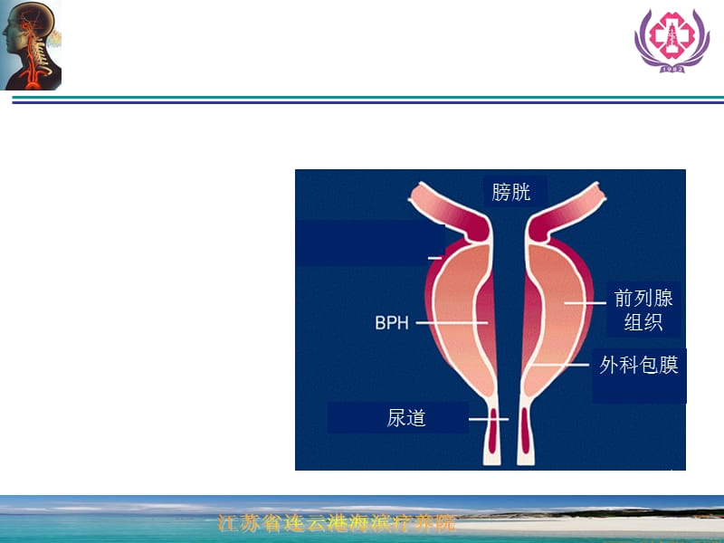 前列腺增生症的诊断治疗.ppt_第3页