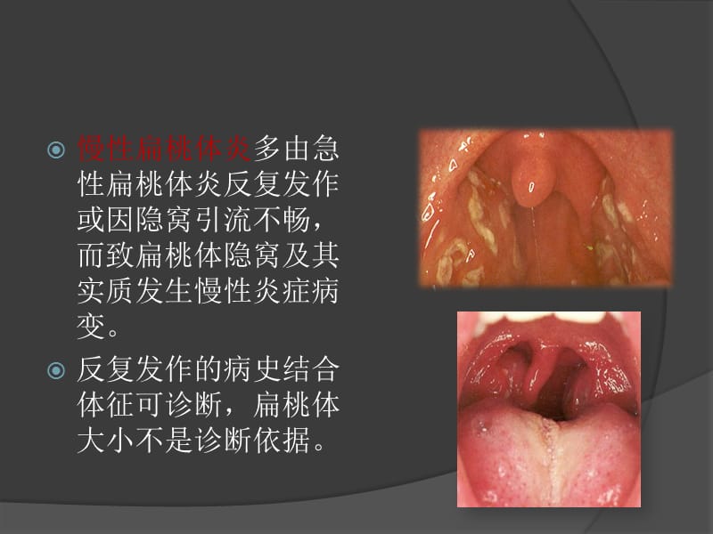 扁桃体切除对IgA肾病的影响.ppt_第3页