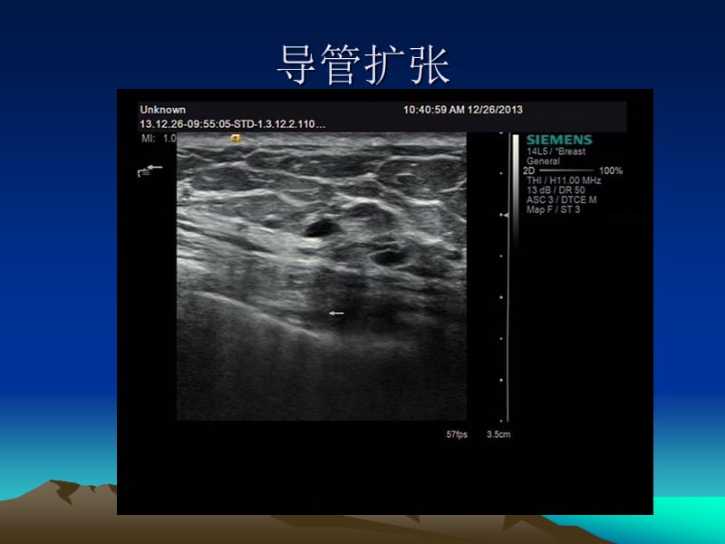 乳癌钙化超声与钼靶典型对比图.ppt_第2页