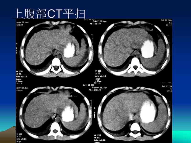 Willson病.ppt_第3页