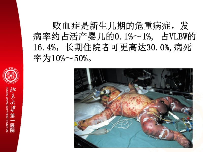 新生儿败血症(医师协会).ppt_第2页