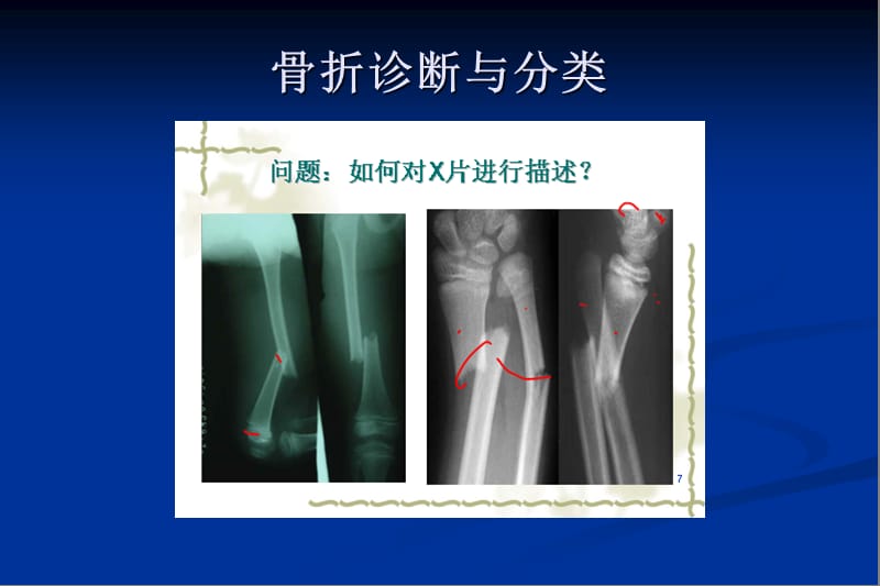 上肢骨折传统治疗技巧讲座.ppt_第2页