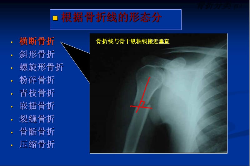 上肢骨折传统治疗技巧讲座.ppt_第3页