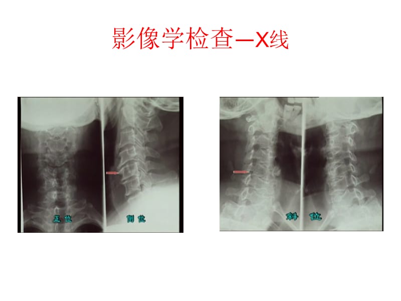 颈椎病的诊断与治疗.ppt_第2页