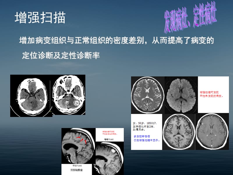 脑肿瘤CT和MR诊断 (1).ppt_第3页