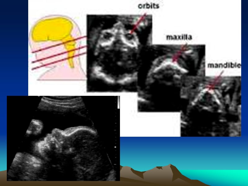 胎儿面部和颈部畸形的超声诊断(1).ppt_第3页