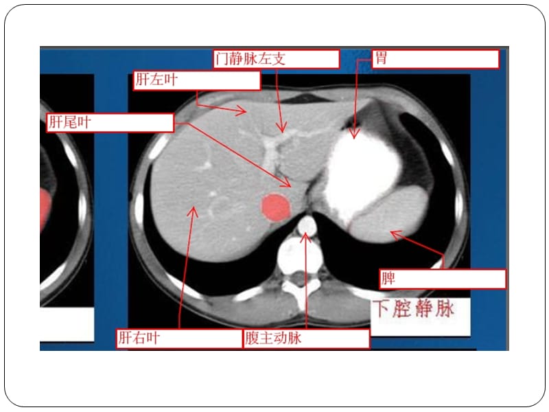 腹部CT示意图.ppt_第2页