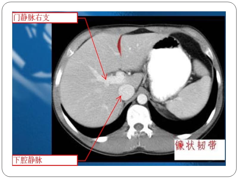 腹部CT示意图.ppt_第3页