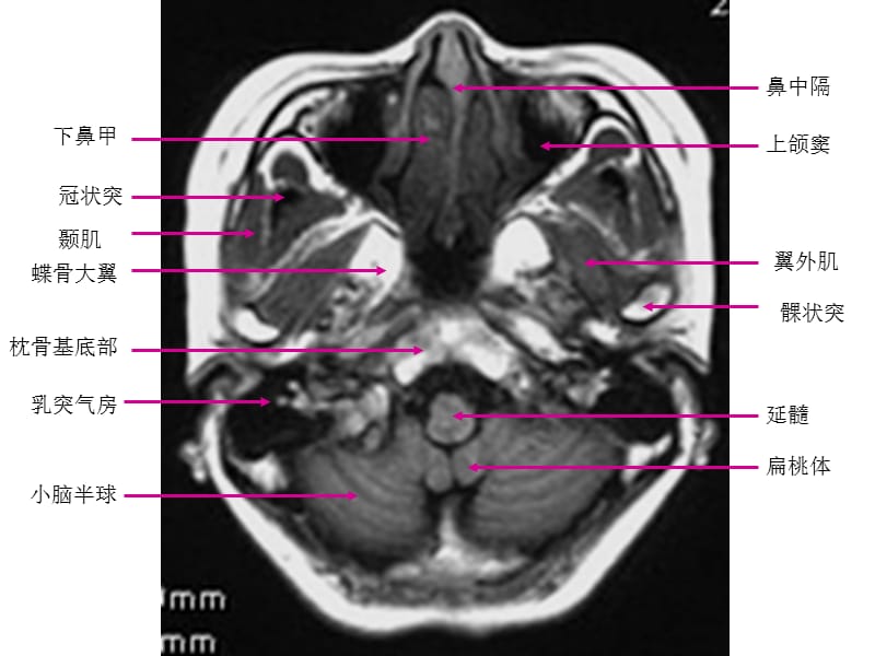 影像解剖案例.ppt_第2页