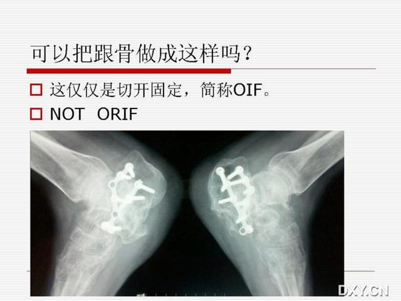 跟骨骨折复位46页PPT课件ppt课件.ppt_第2页