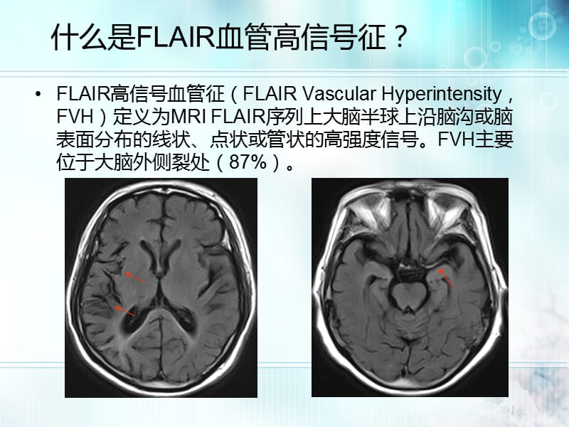 论文交流-张卫-FLAIR血管高信号征对急性前循环脑梗死的临床评价作用.ppt_第3页