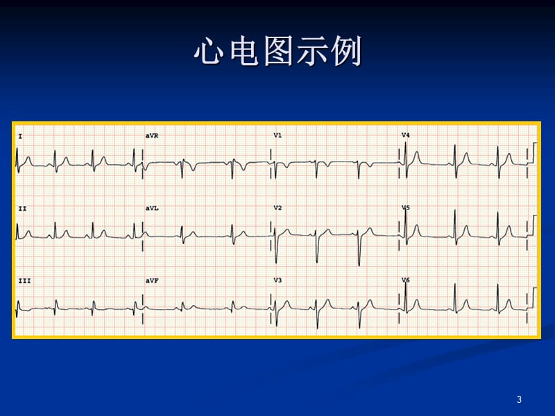 张琼玉正常心电图和.ppt_第3页