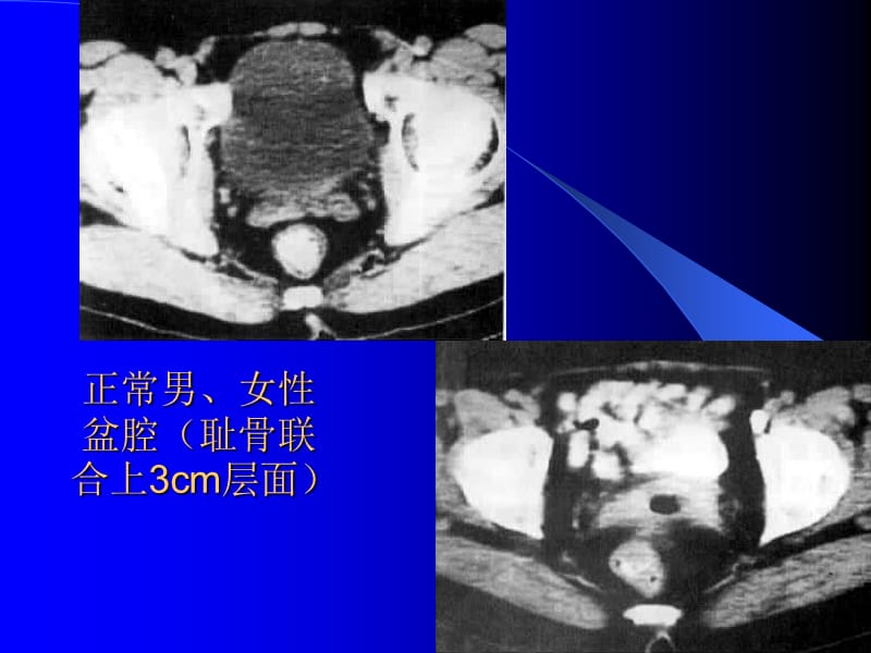 腹腔及腹膜后CT诊断2.ppt_第3页