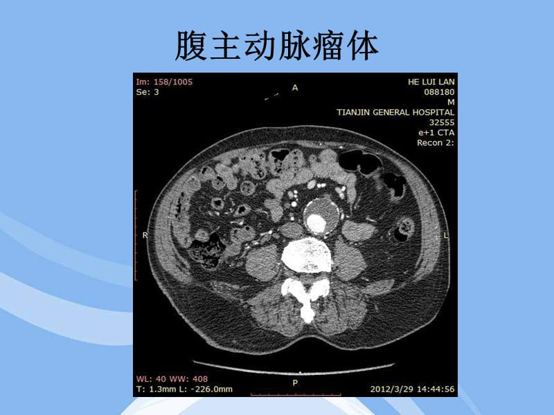 输入道闭塞扭曲腹主动脉瘤合并髂动脉多发动脉瘤一例.ppt_第2页