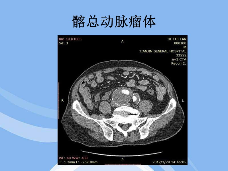 输入道闭塞扭曲腹主动脉瘤合并髂动脉多发动脉瘤一例.ppt_第3页