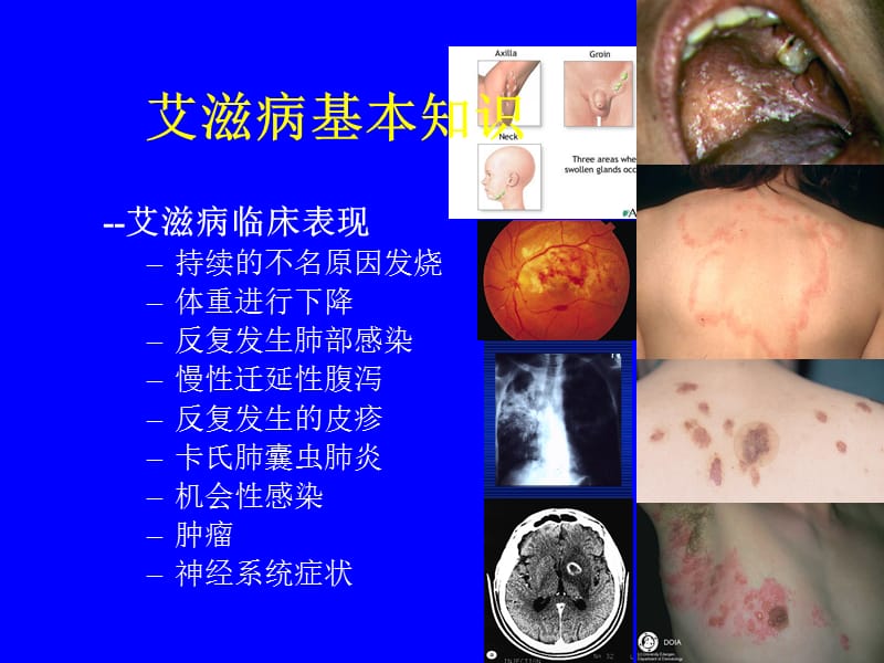 艾滋病基本知识.ppt_第2页