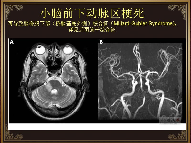 脑血管解剖及脑梗塞定位诊断-迷路动脉.ppt_第2页