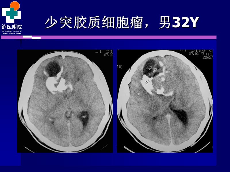 颅脑肿瘤的CT诊断(4).ppt_第3页