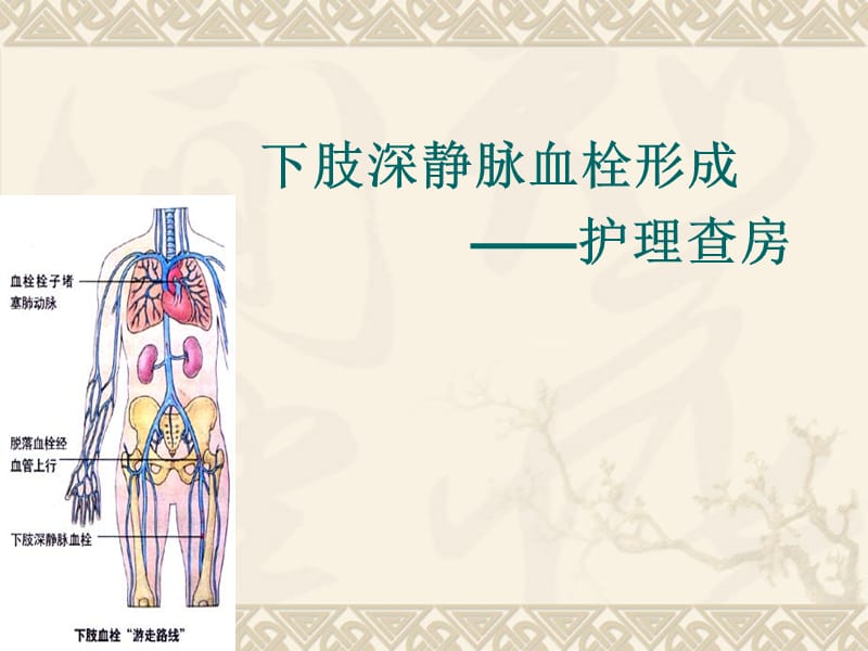 下肢深静脉血栓查房.ppt_第1页