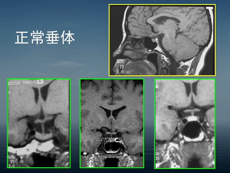 鞍区病变的CT及MRI诊断.ppt_第3页