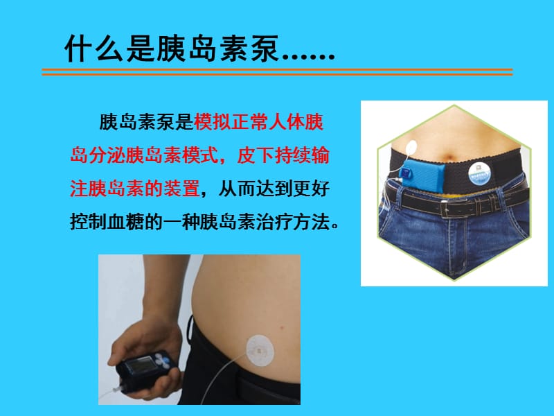 胰岛素泵治疗糖尿病简述.ppt_第3页