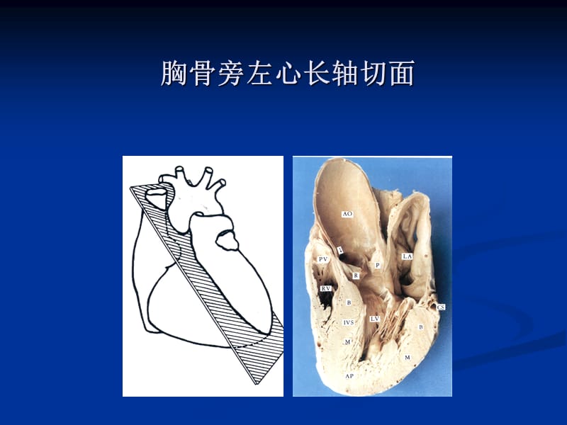 心脏超声基础与应用-讲课.ppt_第3页