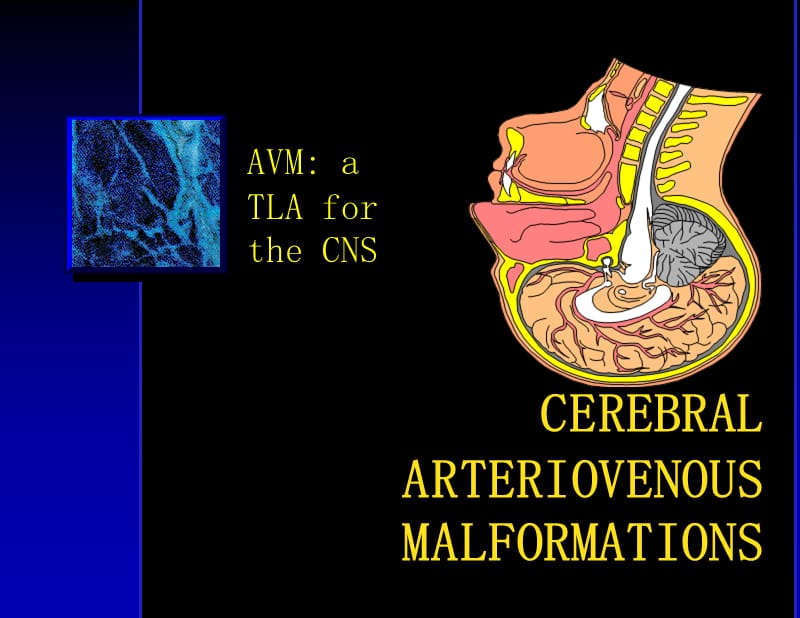 脑动静脉畸形.ppt_第1页