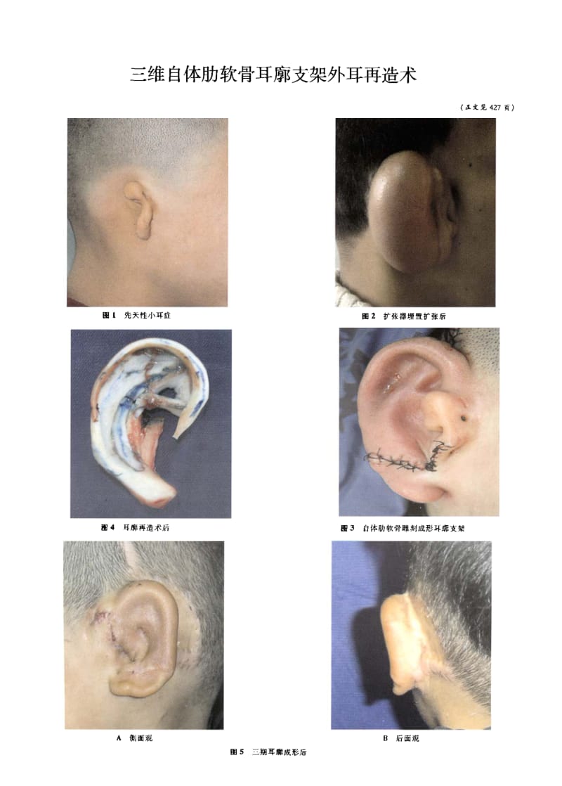 三维自体肋软骨耳廓支架外耳再造术.pdf_第3页