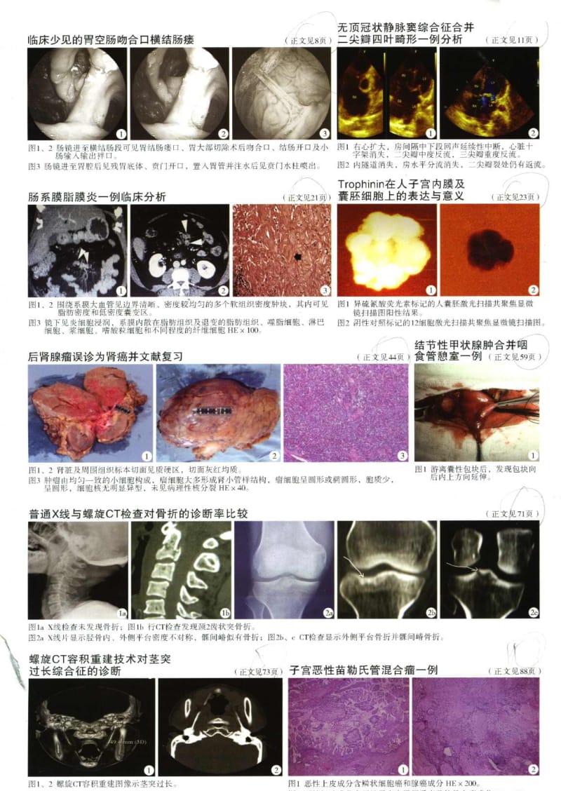 子宫恶性苗勒管混合瘤一例.pdf_第2页