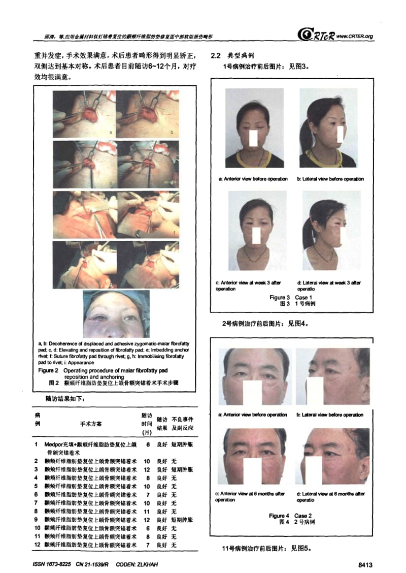 应用金属材料钛钉锚着复位的颧颊纤维脂肪垫修复面中部软组损伤畸形.pdf_第3页