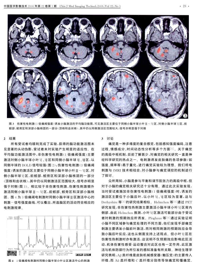 小脑参与痛觉调节的FMRI研究.pdf_第3页