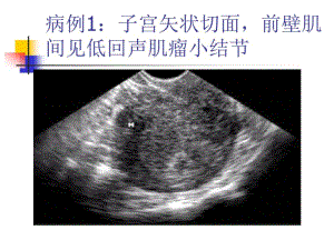 妇科超声诊断病例及图片.pdf