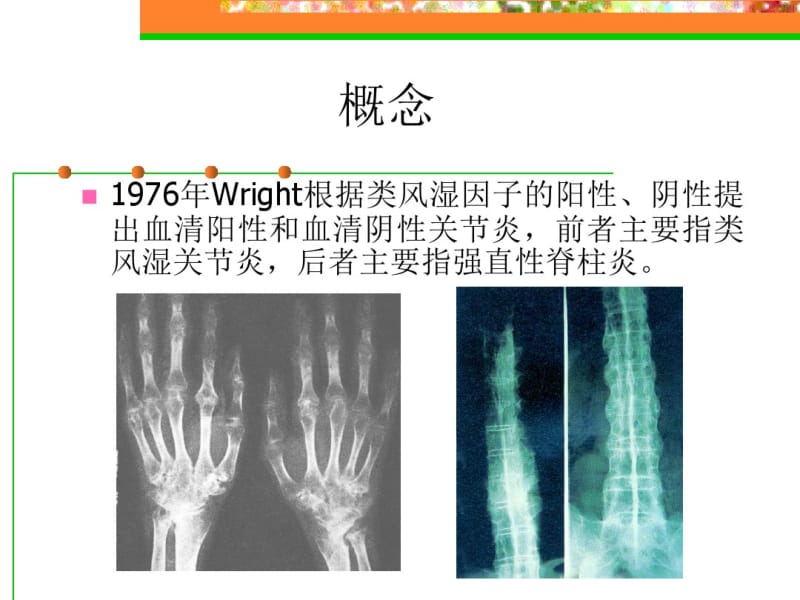 类风湿关节炎(rheumatoidarthritis,RA)是一种以关节病变.pdf_第3页