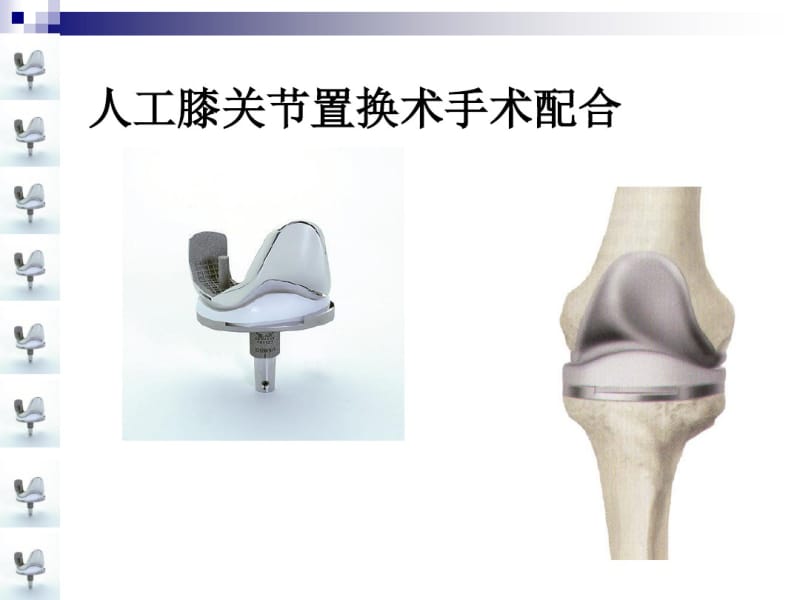 人工膝关节置换术手术配合ppt..pdf_第1页