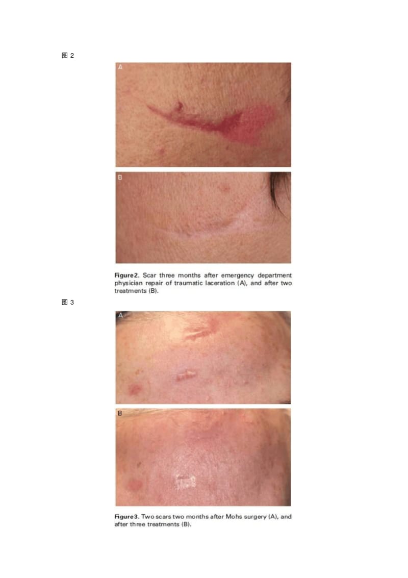 点阵激光治疗手术后疤痕讲解.pdf_第3页