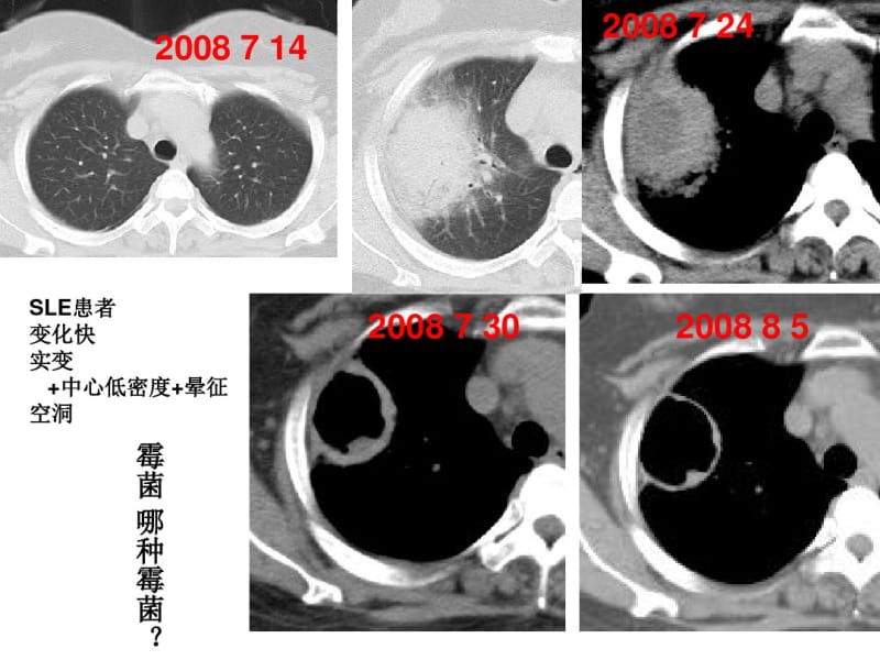 肺霉菌病MSCT诊断讲义.pdf_第2页