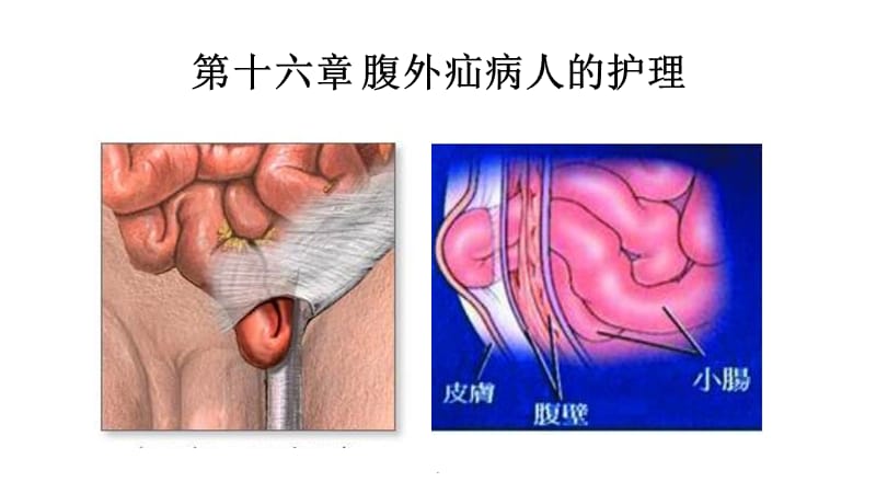 腹外疝病人的护理最新版本.ppt_第1页