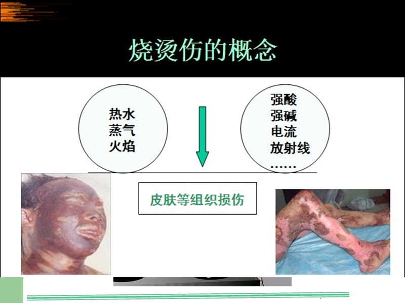 烧烫伤的院前急救.ppt_第3页