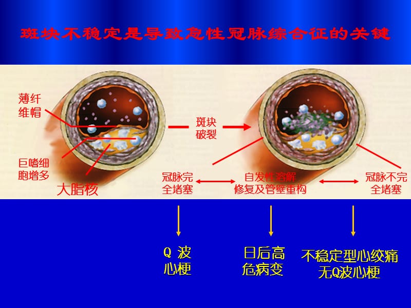 急性心肌梗死PPT课件；.ppt_第2页