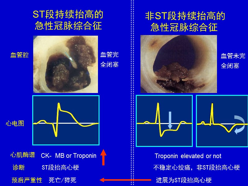 急性心肌梗死PPT课件；.ppt_第3页