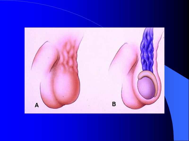 精索静脉曲张(传)；.ppt_第2页