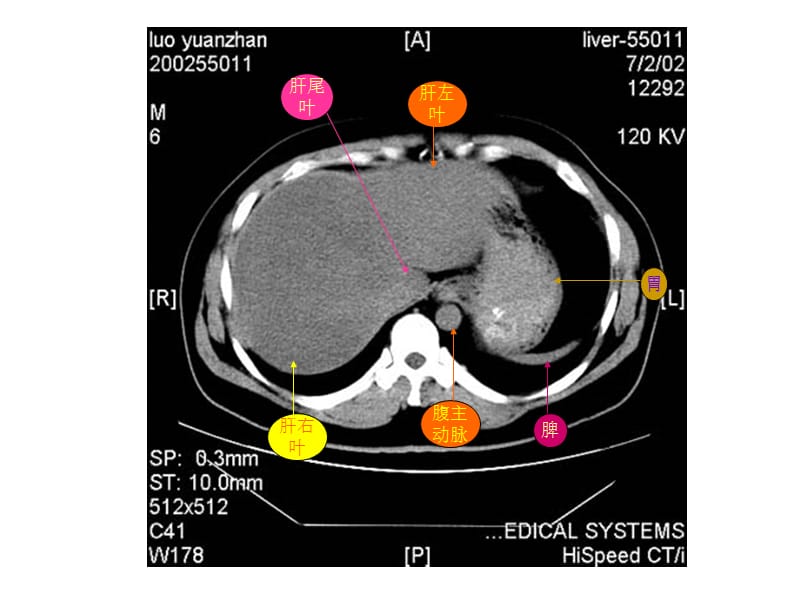 教你如何看腹部CT；.ppt_第3页