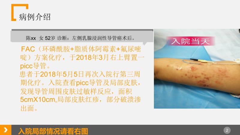 PICC案例分享.ppt_第2页