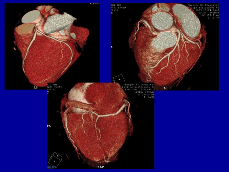 冠状动脉CTA成像.ppt_第3页