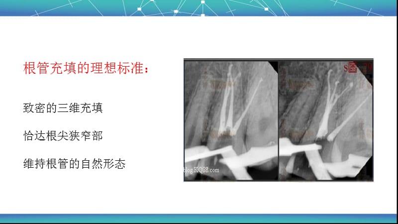 根管治疗术(五)：根管充填.ppt_第3页