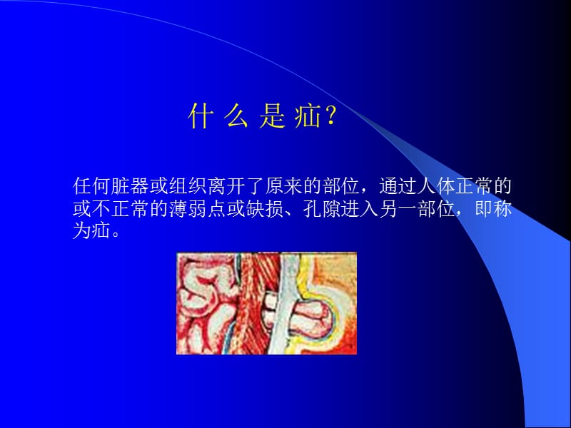 小儿腹股沟斜疝.ppt_第2页