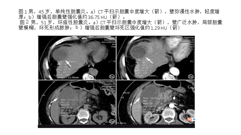 胆囊炎与坏疽性胆囊炎的CT诊断和鉴别诊断.ppt_第3页